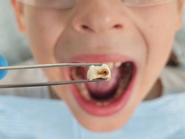 Best Emergency Wisdom Tooth Extraction in Gore, OK